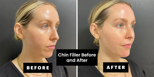 Chin Filler Before and After: Everything You Need to Know