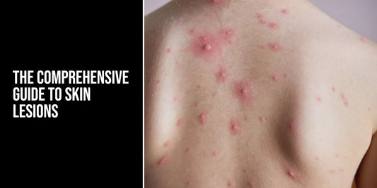 skin lesions